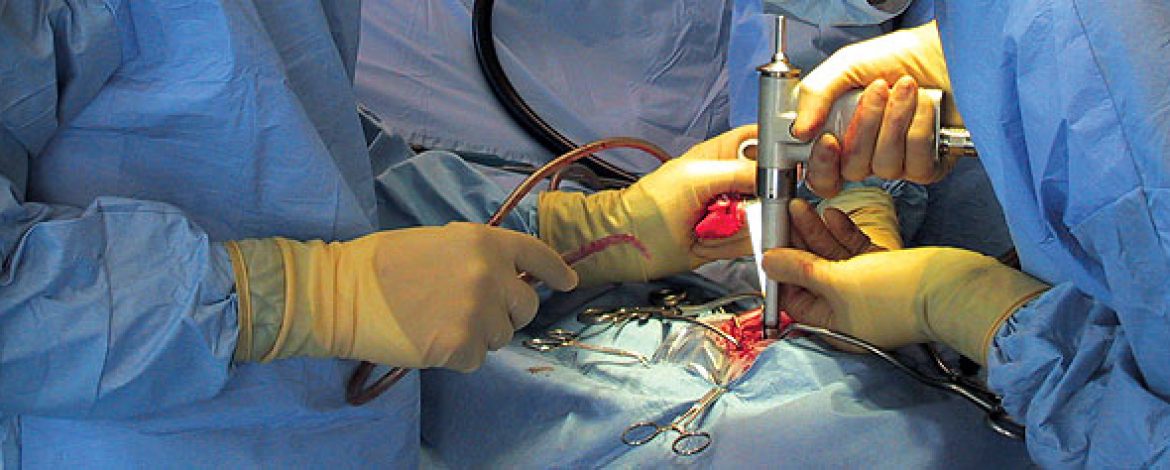Enhancing Mobility: Understanding Total Hip Replacement Surgery