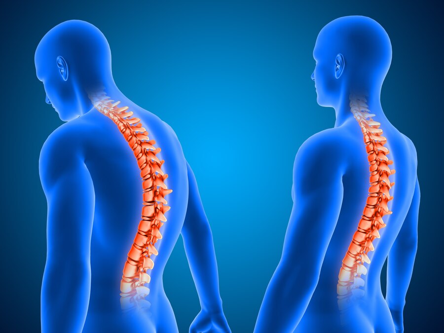 Scoliosis - Surgery - Orthopedic-Treatment - (Dr Vijaya Krishnan - Orthovijay - life span - life span clinic)
