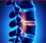 Slip - Disc - Treatment - Orthopedic-Treatment - (Dr Vijaya Krishnan - Orthovijay - life span - life span clinic)