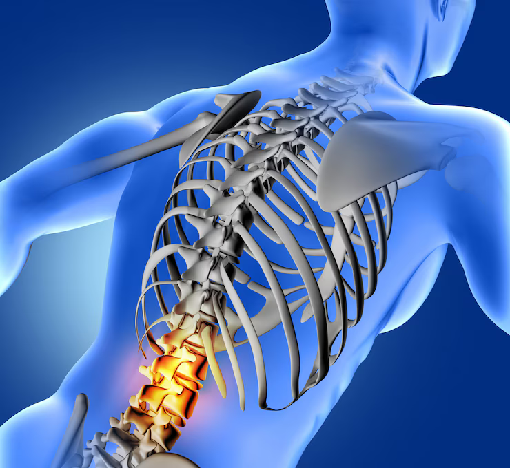 Spinal - Fusion - Surgery - Orthopedic-Treatment - (Dr Vijaya Krishnan - Orthovijay - life span - life span clinic)