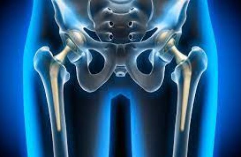 Hip - Replacement - Surgery - Orthopedic-Treatment - (Dr Vijaya Krishnan - Orthovijay - life span - life span clinic)