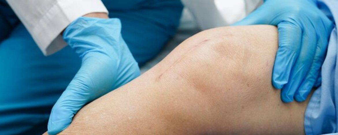 Regain Your Mobility with Expert Knee Replacement Surgery